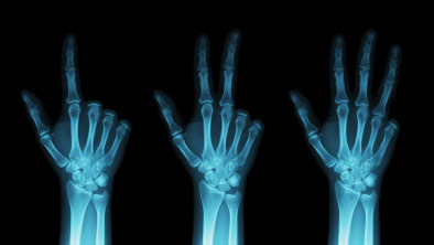 Облучение человека - рентгенограмма руки